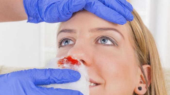 Begini Cara Mengatasi Mimisan pada Anak