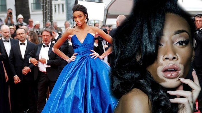 Menderita Kelainan Kulit Sejak Umur 4 Tahun, Siapa Sangka Wanita ini Sekarang Buat Orang Takjub