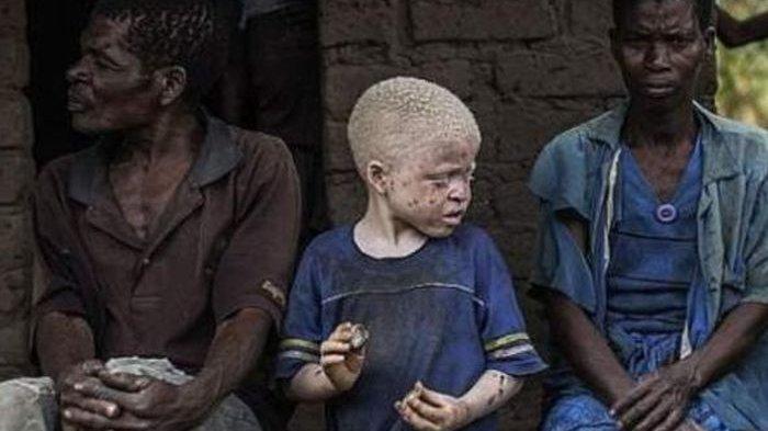 Mengerikan Beginilah Nasib Bocah Kulit Putih Terlahir dari Orangtua Kulit Hitam, Dianggap Keramat