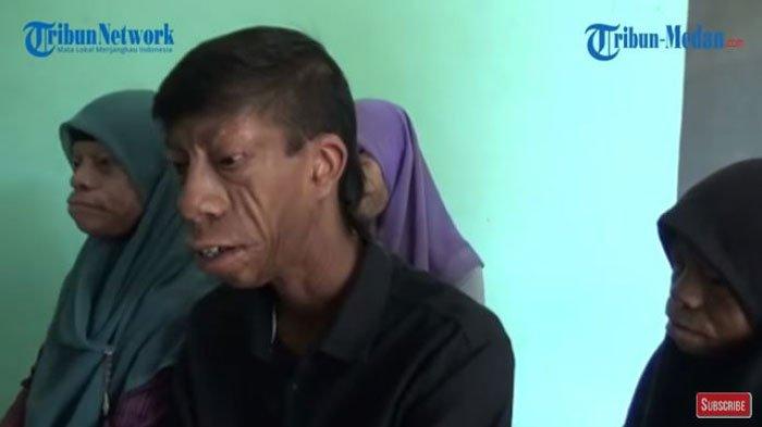 Kisah Kehidupan Keluarga Pengidap Sindrom Treacher Collins di Asahan, Viral di Tiktok