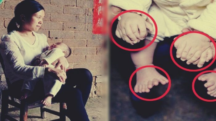 Orang Tua Syok Liat Bayinya Miliki Banyak Jari Tangan dan Kaki,Dokter Lalu Ungkap Penyebab,Ternyata