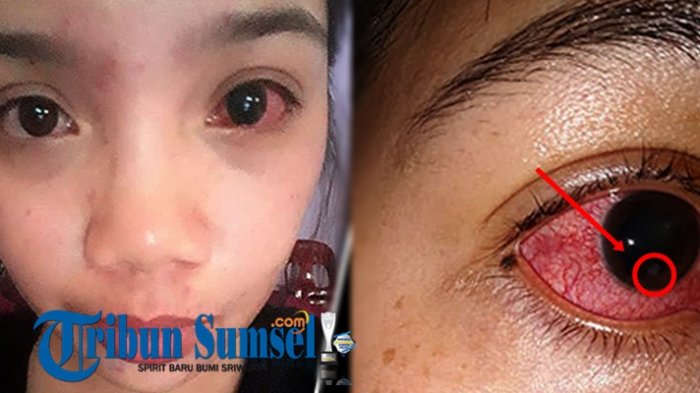 Usai Bangun Tidur,Mata Sulit Dibuka,Lalu Nyeri Sampai ke Kepala,Tak Diduga Penyebabnya Ternyata