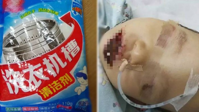 Ngeri ! Bibir Berdarah Dan Ungu,Anak Ini Dilarikan Ke Rumah Sakit,Penyebabnya Bikin Ibunya Menyesal