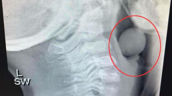 Ngeri ! Wanita Ini Bagikan Foto X-ray Bocah 5 Tahun yang Ditenggorakan Tersangkut Anggur !