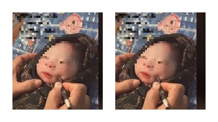Heboh Pipi Bayi Ditusuk dengan Pensil Eyeliner agar Terbentuk Lesung Pipi, Berikut Penjelasan Dokter