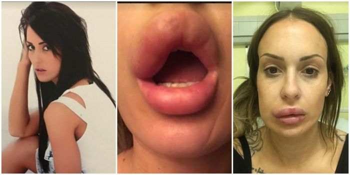 Mau Tampil Cantik Dengan Cara Instan, Wanita Ini Justru Terancam Kehilangan Bibirnya