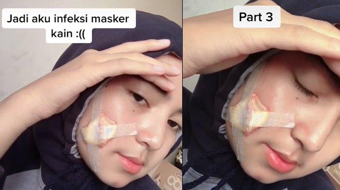 Awalnya Jerawat Berujung di Ruang Operasi, Viral Seorang Perempuan Diduga Terinfeksi Masker Kain