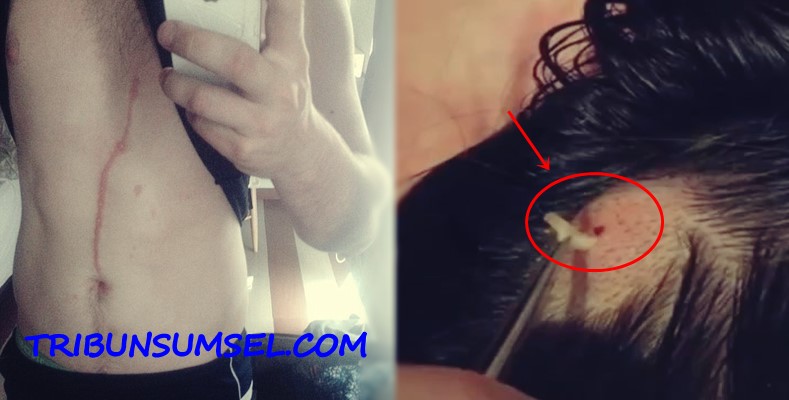 7 Parasit Paling Menakutkan Ini Pernah Ditemukan Hidup di Dalam Tubuh Manusia,Nomor.6 Ngeri!