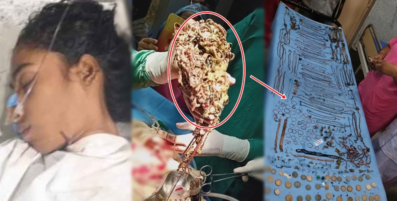 Wanita Berusia 26 Tahun 'Menelan' Perhiasan Seberat 1,6 Kg, Dokter Syok Saat Membedah Isi Perutnya