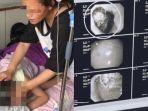 ibu-kaget-saat-lihat-gumpalan-berdiameter-18-sentimeter-di-perut-anak-9-tahunnya-ternyata-makan-ini.jpg