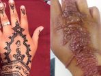 pakai-henna-malah-kulit-melepuh_20170506_130304.jpg