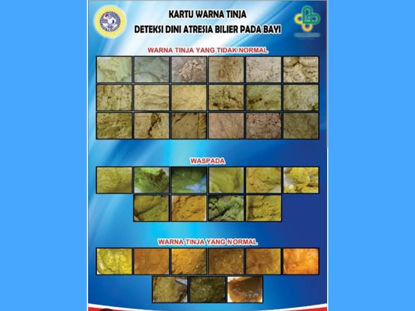 Terlambat Bisa Fatal. Waspada Kuning Dan Tinja Pucat Pada Bayi Lebih Dari Dua Minggu