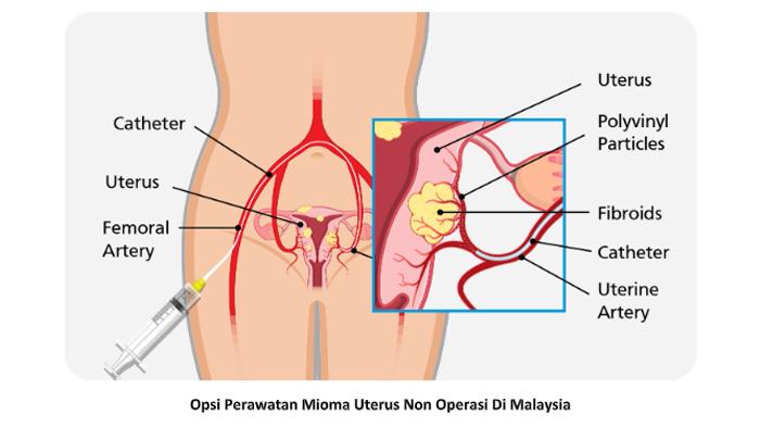 Opsi-Perawatan-Mioma-Uterus-Non-Operasi-Di-Malaysia.jpg