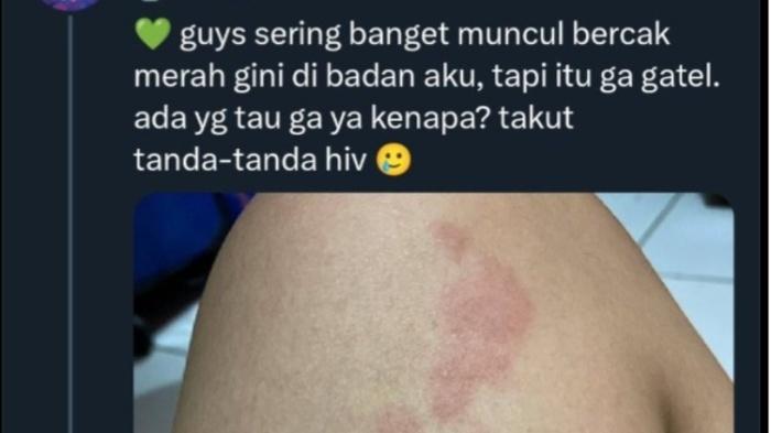 Warganet-curhat-takut-terinfeksi-HIV-gara-gara-sering-muncul-ruam-merah-di-tubuh.jpg