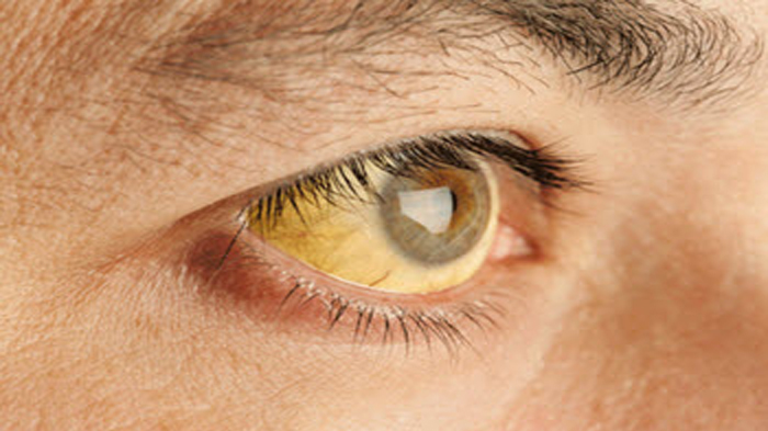 Musim Hujan, Waspadai 5 Jenis Penyakit Berikut