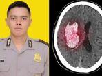 Apa-Itu-Pendarahan-Otak-Penyebab-Bharada-Andika-Gugur-Usai-Ikut-Tradisi-Penyambutan-Brimob.jpg
