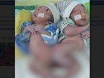 pemisahan-bayi-siam-di-Tulungagung.jpg