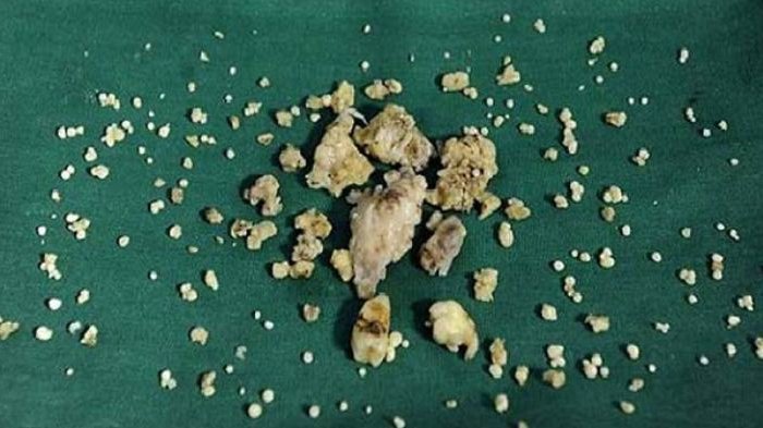 Dokter Berhasil Mengeluarkan Ratusan Benda Ini dari Dalam Mulut Pemuda, Ternyata . . . Ngeri Banget