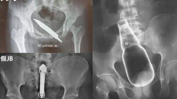 Perhatikan Deretan Foto Hasil Rontgen Ini, Kok Bisa Benda Tak Lazim Ini Ada di Perut?