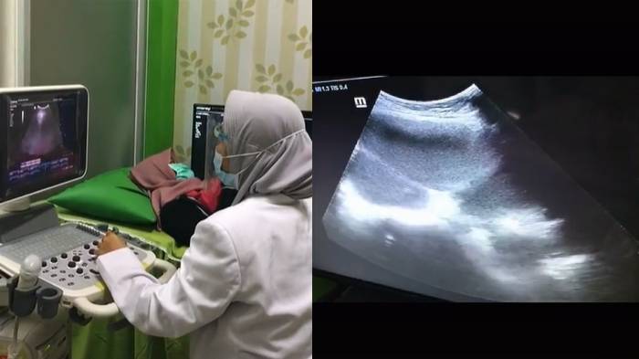 Kronologi Wanita Positif Hamil saat Test Pack Tapi yang Dikandung 9 Bulan Bukan Bayi