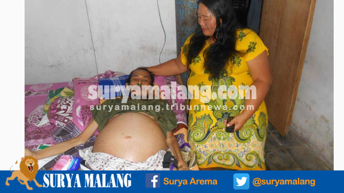 Memprihatinkan, Perut Suyadi Semakin Membesar, Kata Dokter Belum Ada Obatnya