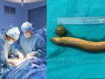 Dokter-Syok-Temukan-Belut-Hidup-di-Perut-Seorang-Pria-Awalnya-Mengeluh-Sakit-Bagaimana-Bisa.jpg