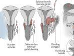ilustrasi-kanker-serviks-kota-batu.jpg