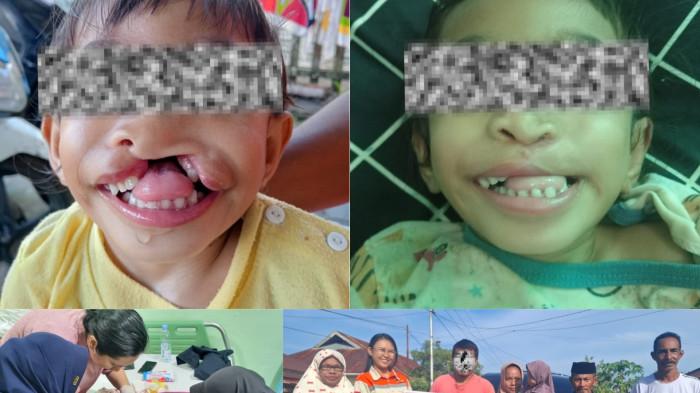 PEDULI: Azzaliarisa Syamsu manjalani proses operasi Labioskizis di dampingi keluarga dan Tim Comdev PT Position di Kota Ternate