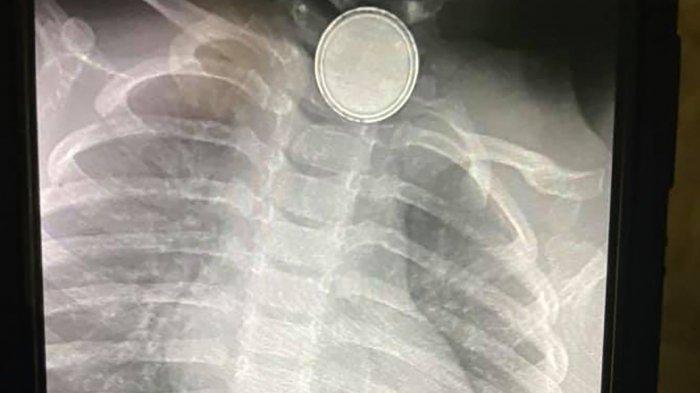 Bayinya Meninggal karena Telan Baterai, Ibu Ini Viralkan Kisahnya: Kita Butuh Produk yang Aman