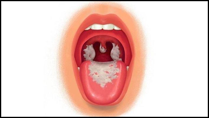 Kasus Difteri Merebak di Ternate, Ridwan Yamko Ingatkan Pentingnya Imunisasi Lengkap