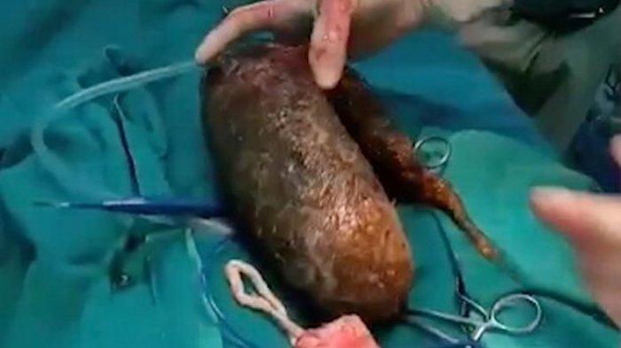 Gegara Hobi Kunyah Rambut, Gumpalan Rambut Seberat 7 Kg Ditemukan di Perut Remaja Asal India
