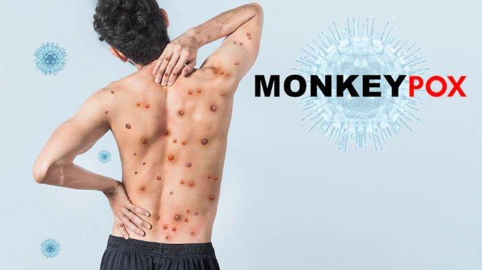 Mengenal Penyakit Zoonosis Cacar Monyet atau Monkeypox, Ini Gejala dan Cara Pencegahannya