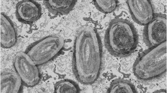 AS Laporkan 2 Kasus Mutasi Virus Cacar Monyet, Apakah Jadi Lebih Mematikan?