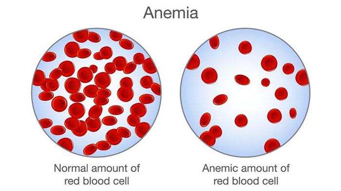 Mengenal Anemia Aplastik, Penyakit Langka Yang Dialami Komika Babe Cabita