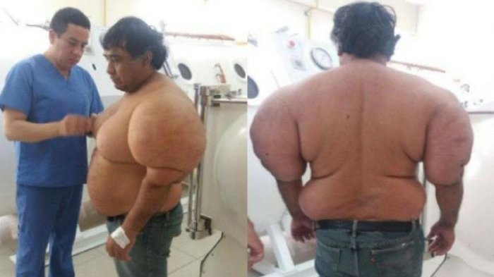Tubuh Pria Ini Berubah hingga Disebut Manusia Balon Cuma karena Lakukan Hal Tak Diduga Usai Menyelam