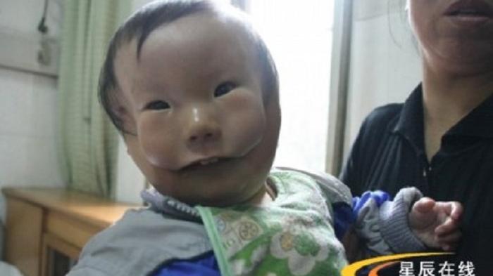 Bayi KangKang - Malang! Inilah Kisah Pilu Anak yang Lahir dengan Wajah Seperti Memakai Topeng