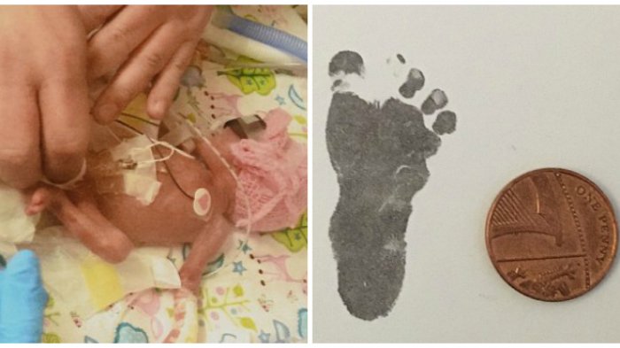 Lahir dengan Cap Kaki Tak Lebih Besar dari Uang Logam, Bayi Ini Alami Hal Menakjubkan
