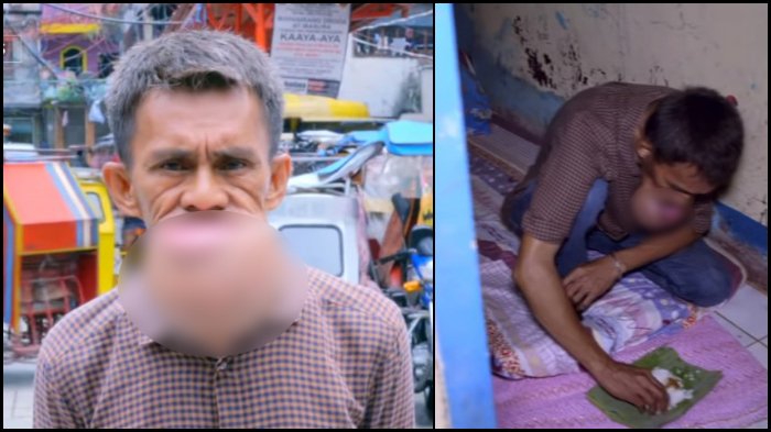 Cabut Gigi Sendiri Pakai Tang Berkarat, Pria asal Filipina Menyesal Seumur Hidup