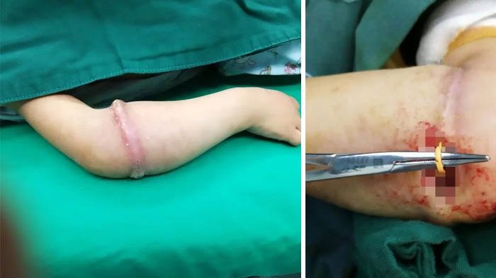 Gadis 4 Tahun Ini Pakai Karet Gelang Terlalu Lama, Ia Akhirnya Alami Hal Mengerikan