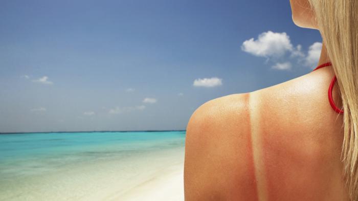 Penting Dipraktikkan! Ini Cara Ampuh Kembalikan Kulit yang Gosong Usai Liburan