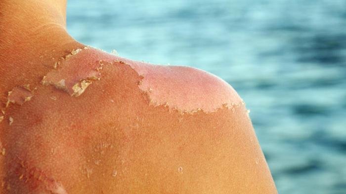Mengerikan! 7 Turis Ini Tunjukkan Tubuh Mereka yang Terbakar Karena Tak Menggunakan Sunscreen