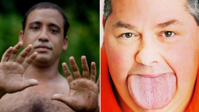 Ckckck! Dari Lidah hingga Bagian Dada Terbesar, Inilah 10 Mutasi Gen Paling Aneh di Dunia
