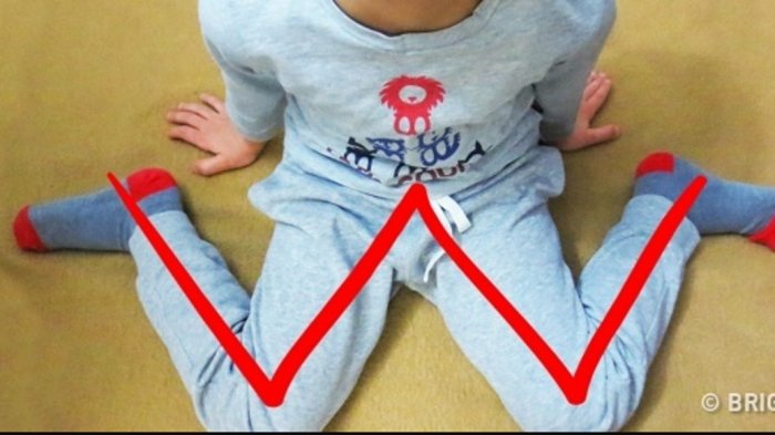 Jangan Dibiasakan! Ada Bahaya Jika Anak Sering Duduk di Lantai dengan Posisi Kaki Seperti Huruf 'W'