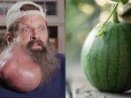 Kolase-foto-jerawat-seorang-pria-bisa-tumbuh-menjadi-sebesar-buah-semangka.jpg