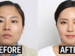 before-after-operasi-plastik_20171223_091615.jpg