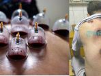 Bikin Merinding! Lakukan Bekam Selama Sebulan, Tubuh Pria Ini Alami Hal Mengerikan