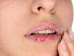 bibir-pecah-pecah.jpg