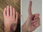 jempol-triphalangeal-memiliki-tulang-ibu-jari-lebih-panjang.jpg