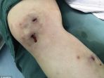 luka-bengkak-di-kaki-gu_20170619_195130.jpg