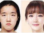 operasi-plastik-di-korea-selatan.jpg